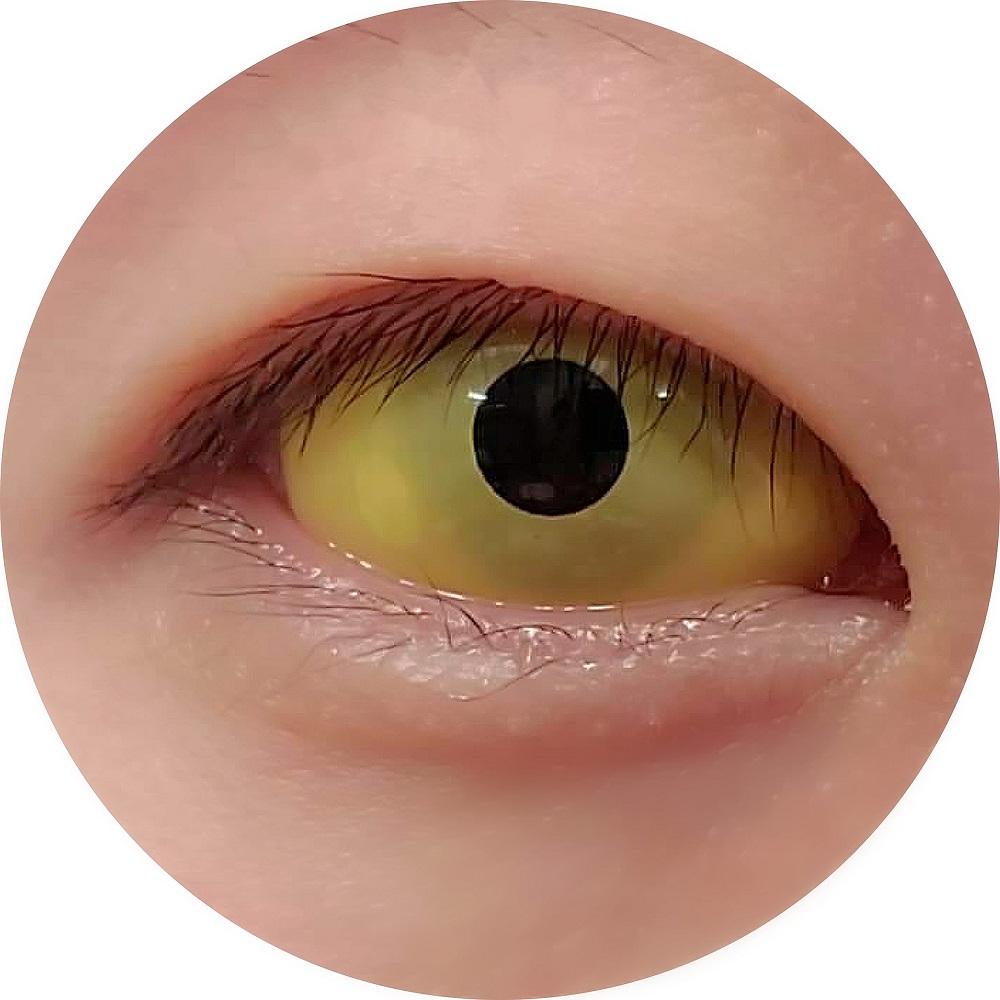 Sweety Yellow Sclera Contacts (1 lens/pack)-Sclera Contacts-UNIQSO Canada